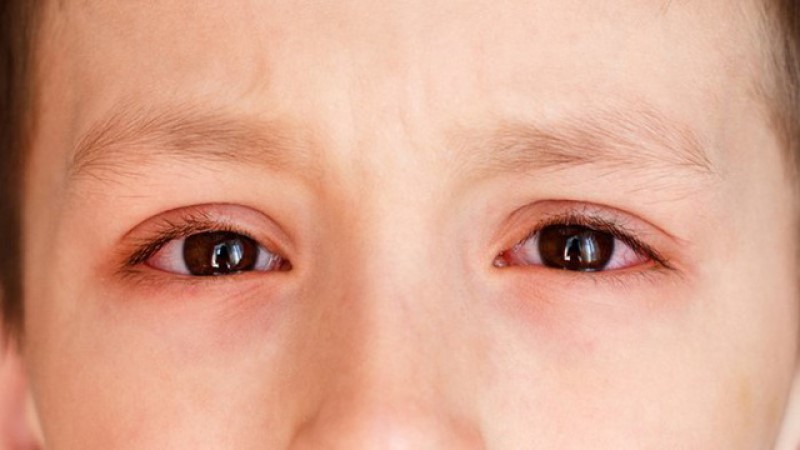 Thiếu hụt Vitamin A ảnh hưởng đến thị giác